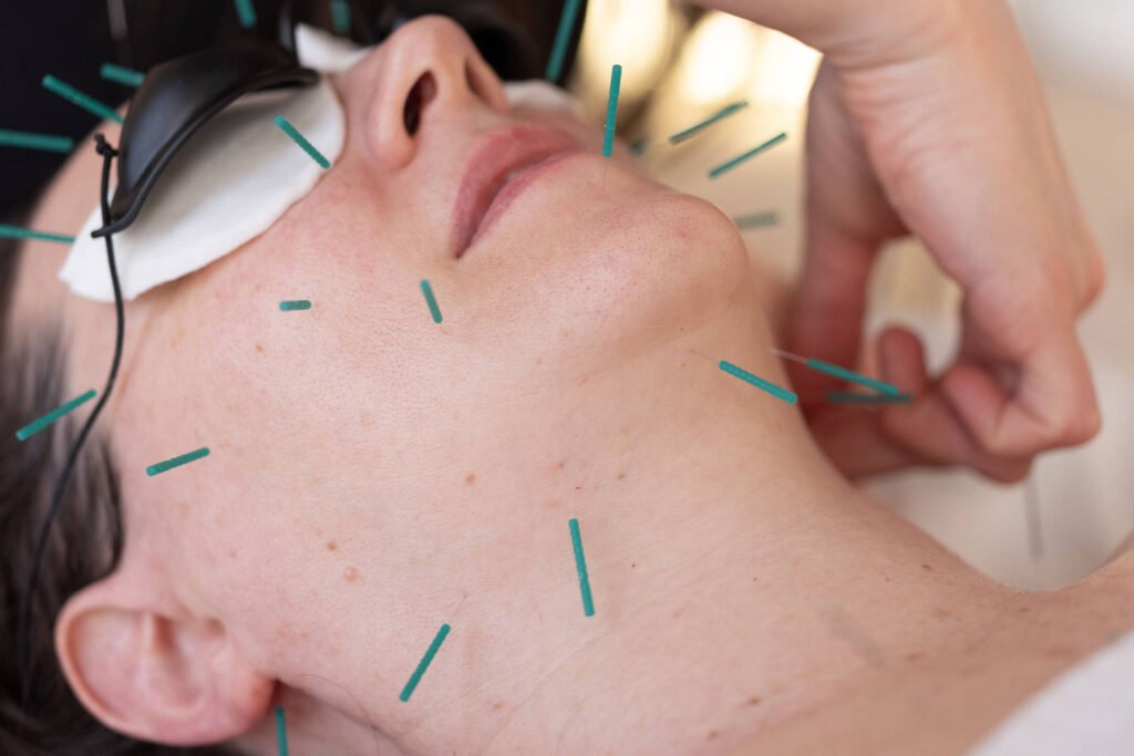 acumpuntura facial em myulhr